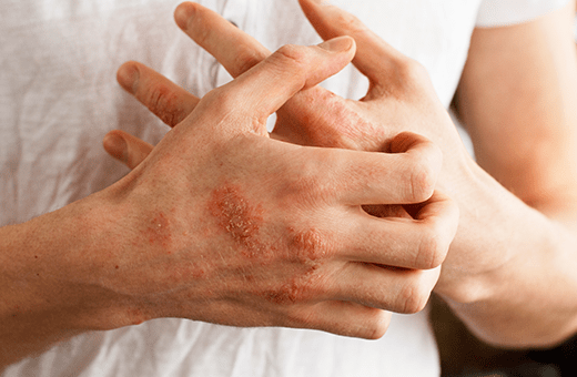 Sedef Hastalığı (Psoriasis)